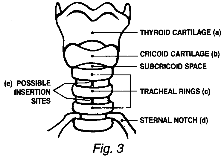 Percutaneous Dilatational Tracheostomy ( PCDT ) Anesthesiaworld