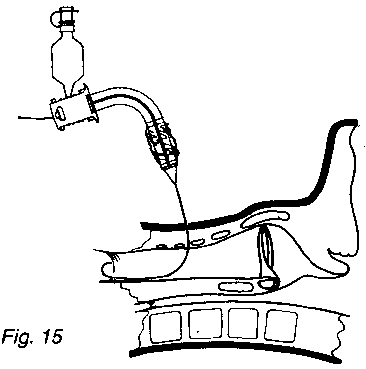 Percutaneous Dilatational Tracheostomy ( PCDT ) Anesthesiaworld