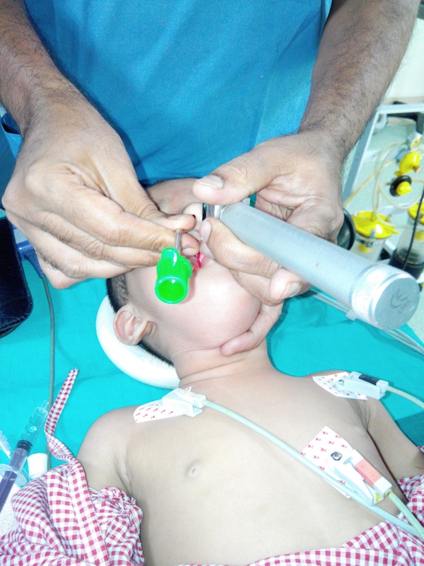 Technique of Bimanual laryngoscopy