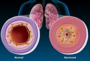 Figure 1: Normal airway vs Narrowed airway due to secretions